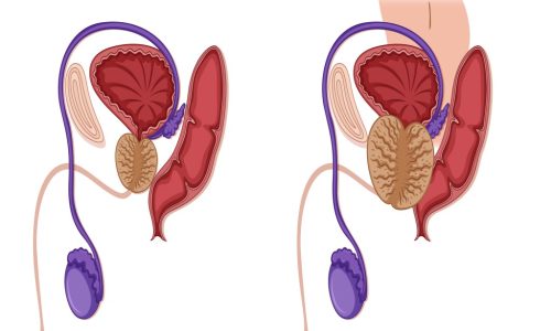 Prostate Enlargement Aururm